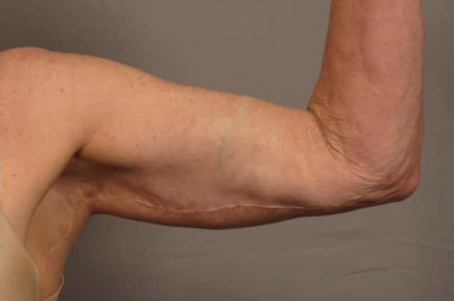 Inside Left Arm 1 Year After Arm Lift (Brachioplasty)