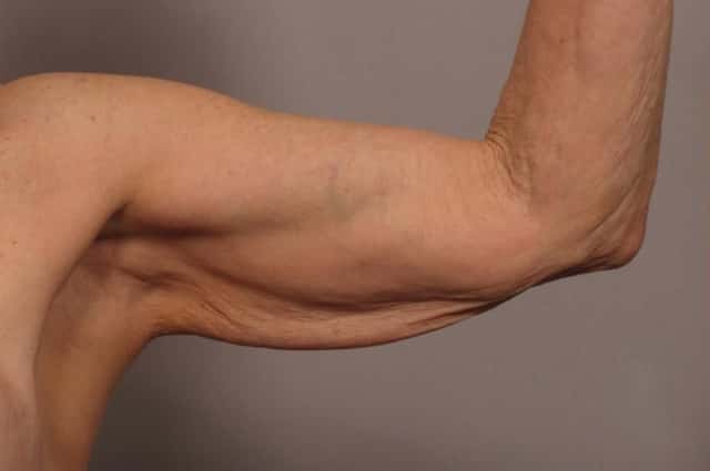 Inside Left Arm Before Arm Lift (Brachioplasty)