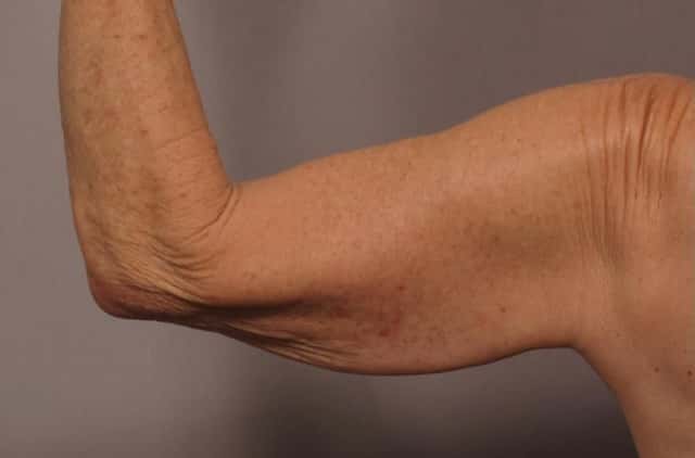 Posterior View of Right Upper Arm Before Arm Lift (Brachioplasty)