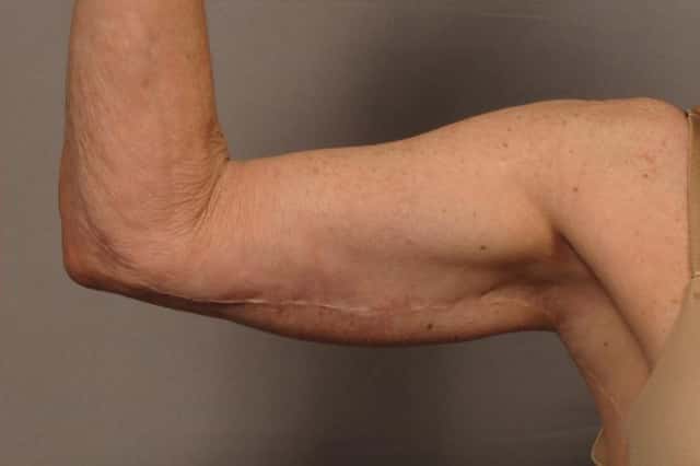 Inside View of Right Upper Arm 1 Year After Arm Lift (Brachioplasty)