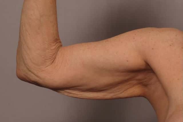 Inside View of Right Upper Arm Before Arm Lift (Brachioplasty)