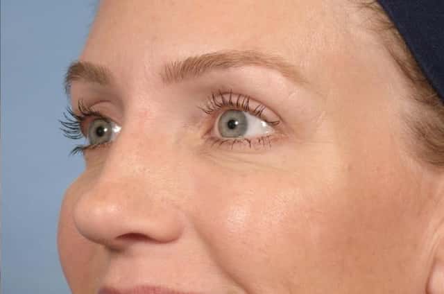 BOTOX® Cosmetic Before & After Case 20 after