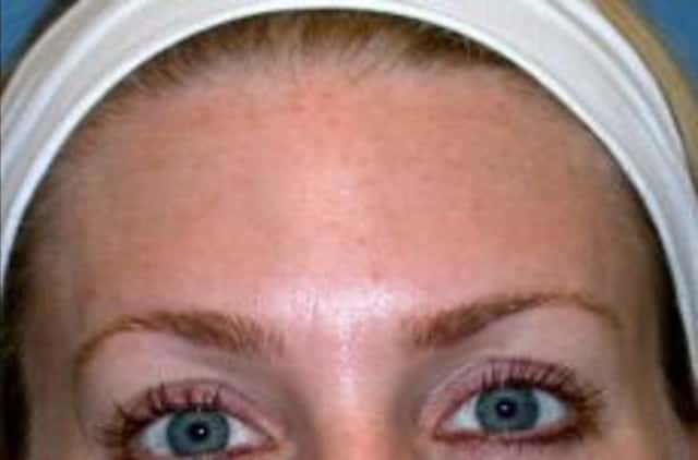 BOTOX® Cosmetic Before & After Case 20 after