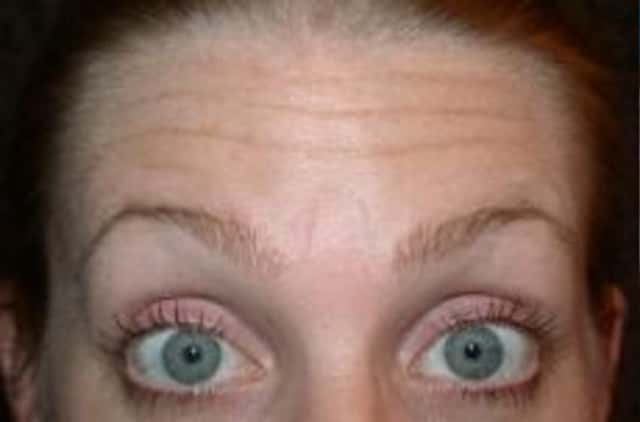BOTOX® Cosmetic Before & After Case 20 before
