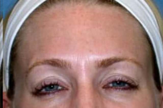 BOTOX® Cosmetic Before & After Case 20 after