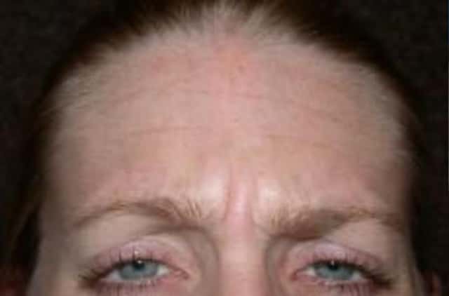 BOTOX® Cosmetic Before & After Case 20 before
