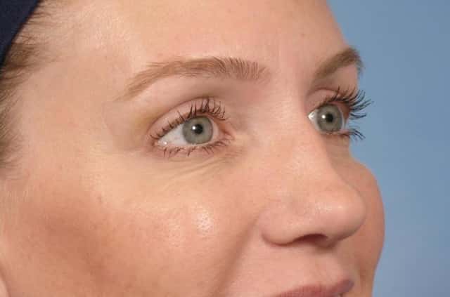 BOTOX® Cosmetic Before & After Case 20 after
