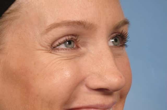 BOTOX® Cosmetic Before & After Case 20 before