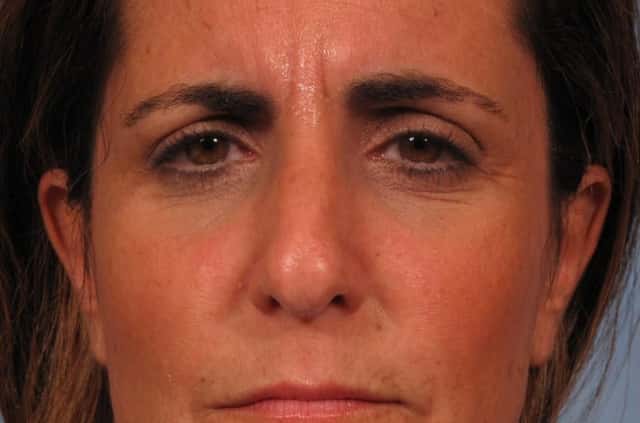 BOTOX® Cosmetic Before & After Case 248 before