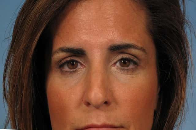 BOTOX® Cosmetic Before & After Case 248 after