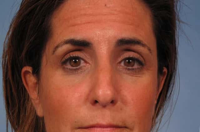 BOTOX® Cosmetic Before & After Case 248 before