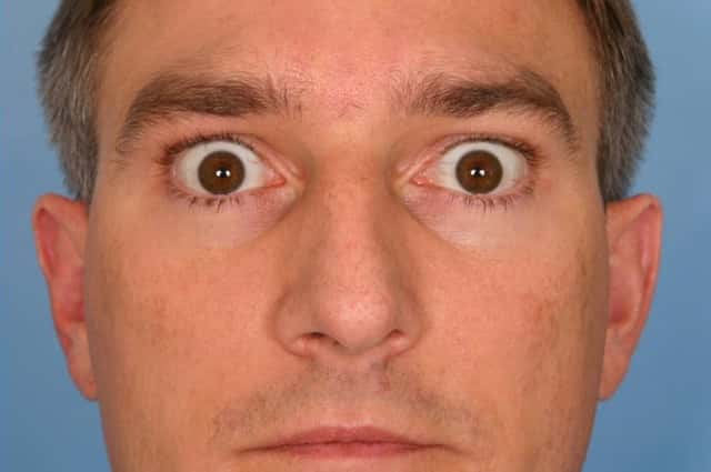 BOTOX® Cosmetic Before & After Case 58 after