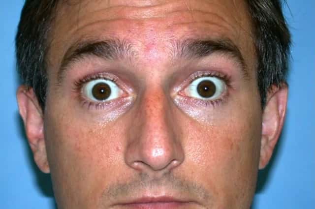 BOTOX® Cosmetic Before & After Case 58 before