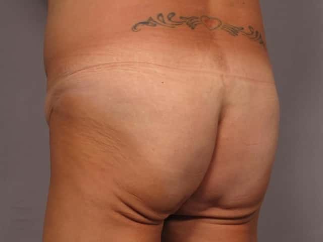 Brazilian Butt Lift Before & After Case 328 before