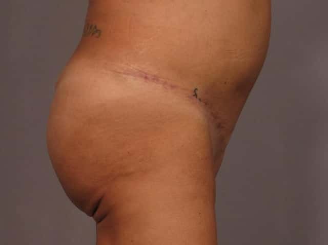 Brazilian Butt Lift Before & After Case 328 after