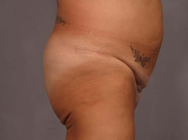 Brazilian Butt Lift Before & After Case 328 before