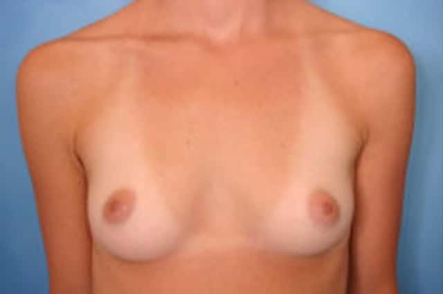 Breast Augmentation Before & After Case 1 before