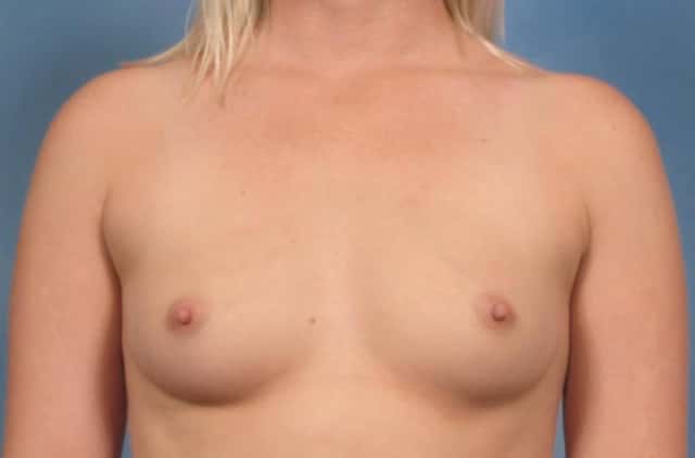 Breast Augmentation Before & After Case 121 before