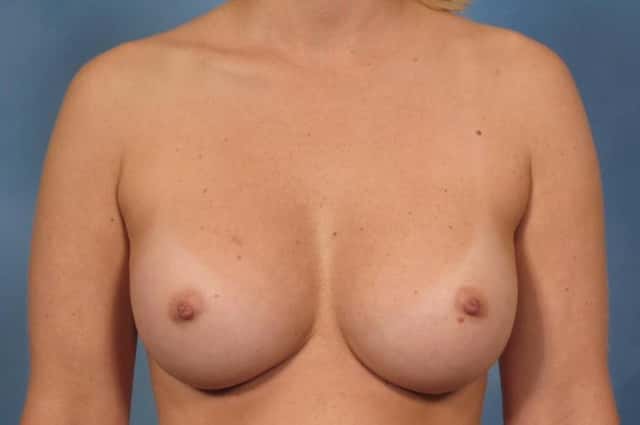 Breast Augmentation Before & After Case 157 after