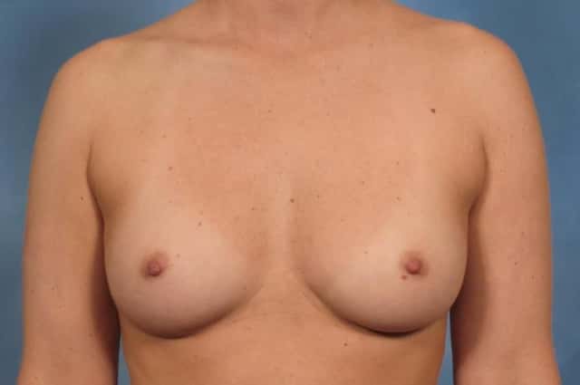 Breast Augmentation Before & After Case 157 before