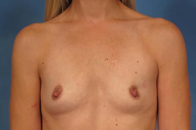 Breast Augmentation Before & After Case 196 before