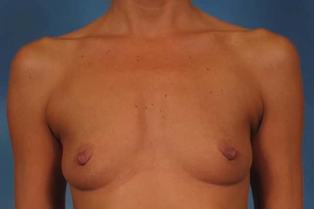Breast Augmentation Before & After Case 205 before