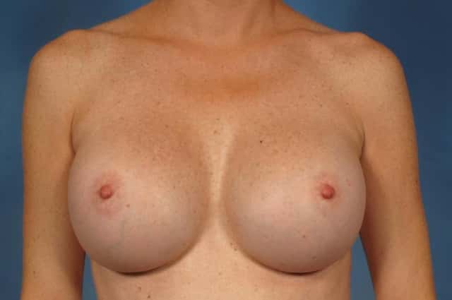Breast Augmentation Before & After Case 228 after
