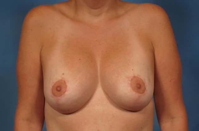 Breast Augmentation Before & After Case 240 after