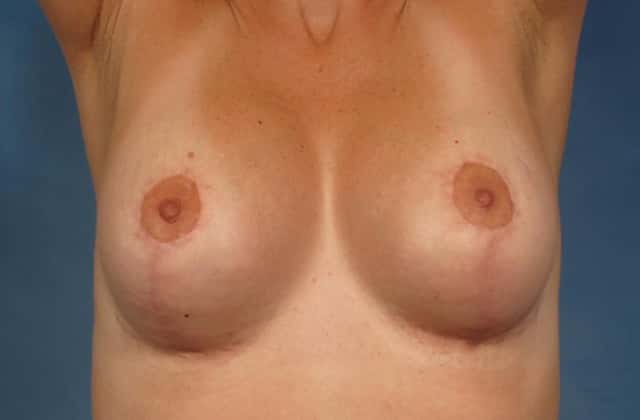 Breast Augmentation Before & After Case 240 after