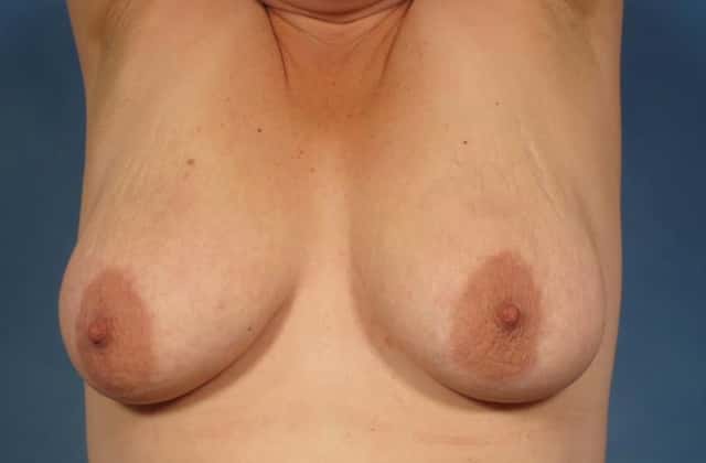 Breast Augmentation Before & After Case 240 before