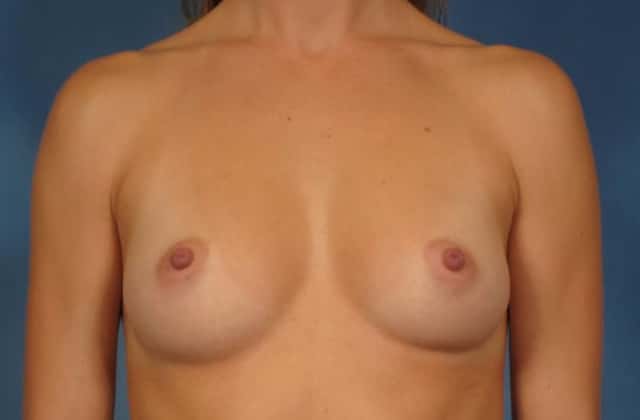 Breast Augmentation Before & After Case 250 before
