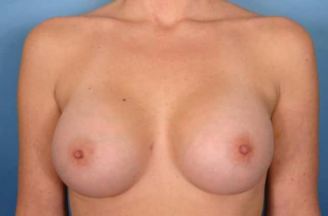 Breast Augmentation Before & After Case 29 after