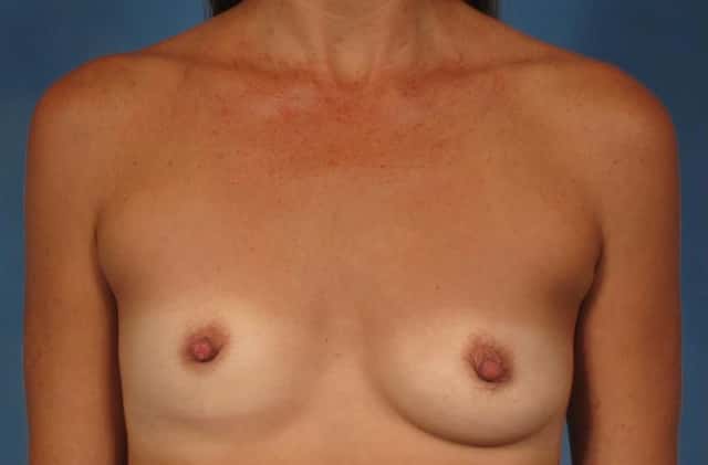 Breast Augmentation Before & After Case 294 before