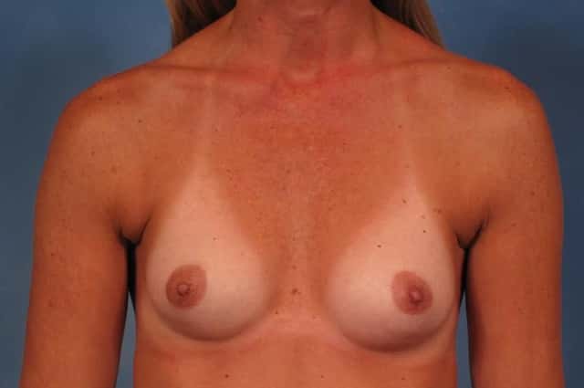 Breast Augmentation Before & After Case 324 before