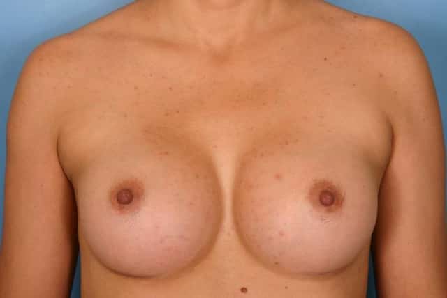 Breast Augmentation Before & After Case 35 after
