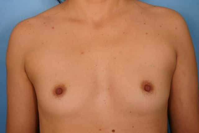 Breast Augmentation Before & After Case 35 before