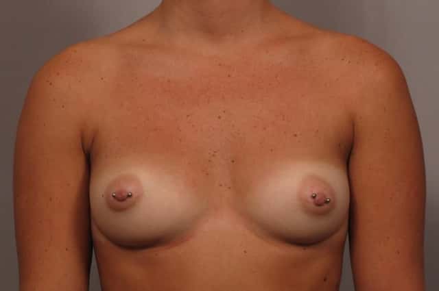 Frontal view of Naples Woman before getting silicone implants by Dr. Kent Hasen