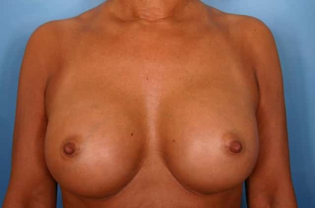 Breast Augmentation Before & After Case 40 after