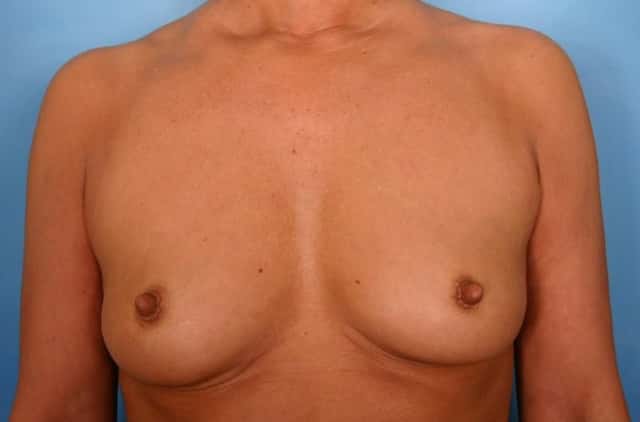 Breast Augmentation Before & After Case 40 before