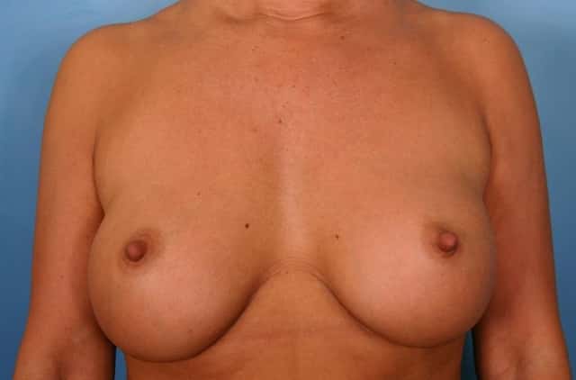 Breast Augmentation Before & After Case 40 after