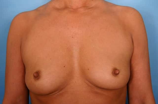 Breast Augmentation Before & After Case 40 before