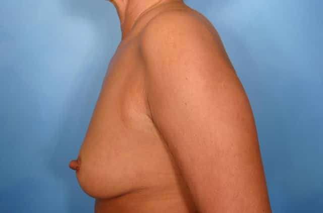 Breast Augmentation Before & After Case 40 before