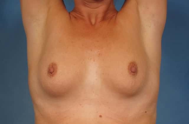 Front Arms Raised view of Breast Augmentation by Dr. Kent Hasen, Before