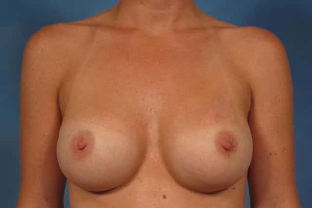 Front view of Silicone Breast Augmentation by Dr. Kent Hasen in 46 year old woman, 1 Year After