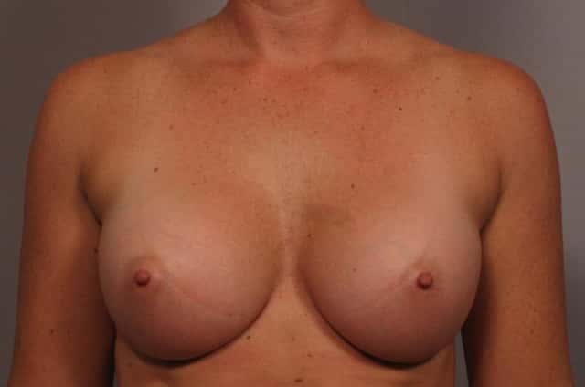 Front view of 31 year old female patient of Dr. Kent Hasen Underwent Breast Augmentation, 3 Months After