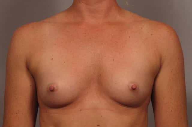 Front view of 31 year old female patient of Dr. Kent Hasen Underwent Breast Augmentation, Before