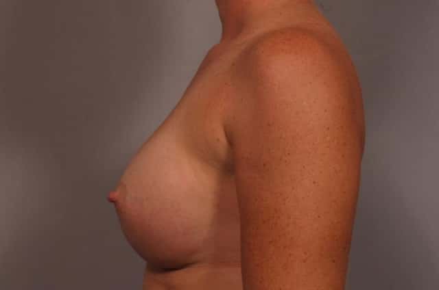 Left Side view of 31 year old female patient of Dr. Kent Hasen Underwent Breast Augmentation, 1 Year After