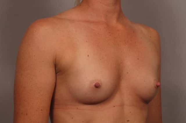 Right Oblique view of 31 year old female patient of Dr. Kent Hasen Underwent Breast Augmentation, Before