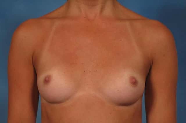 Front view of a 30-year-old breast augmentation patient of Dr. Kent Hasen, Before