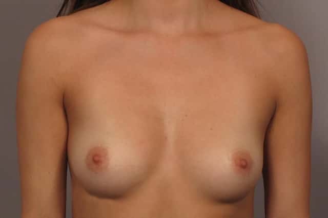 Front view of 23 year old patient of Dr. Kent Hasen who underwent Silicone Breast Augmentation, Before